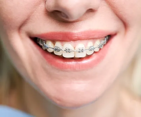 5 Ways Orthodontic Treatment Can Improve Your Confidence and Health