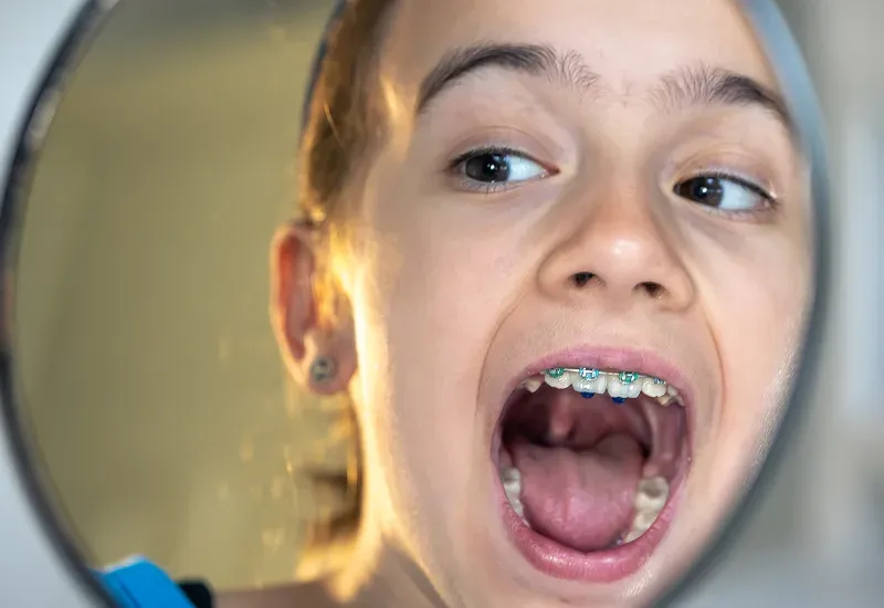 8 Common Myths About Braces—Busted by Orthodontic Experts