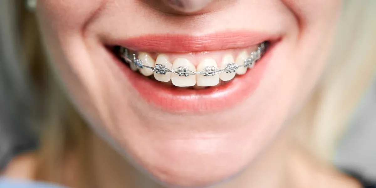 8 Common Myths About Braces—Busted by Orthodontic Experts
